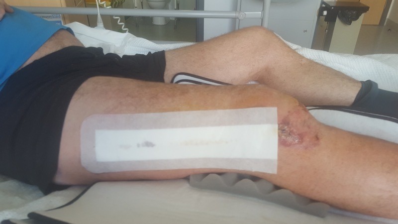Other image for Cyclist speaks out on lasting effects of crash